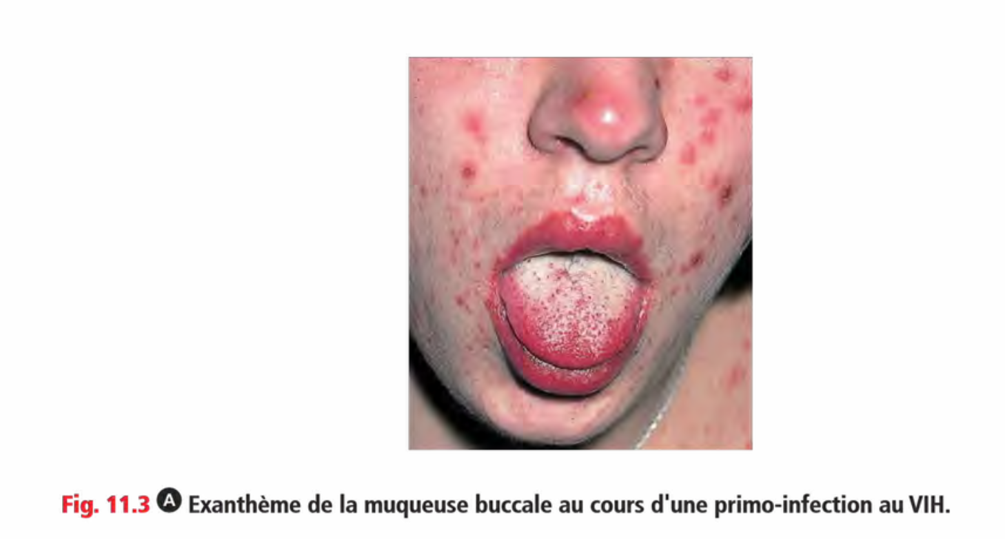 Manifestation cutanéo-muqueuse de primo-VIH