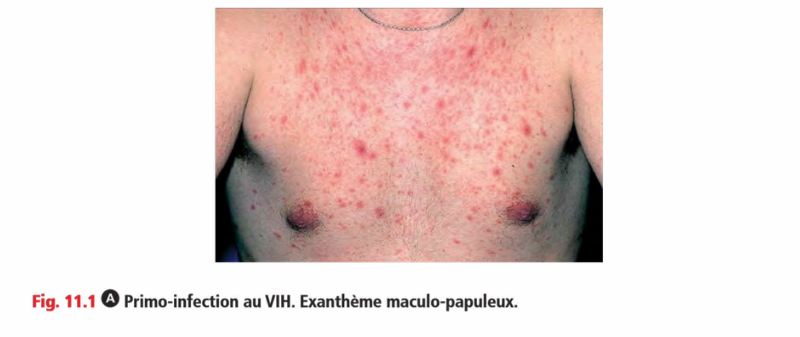 Exanthème maculo-papuleux du tronc en primo-VIH