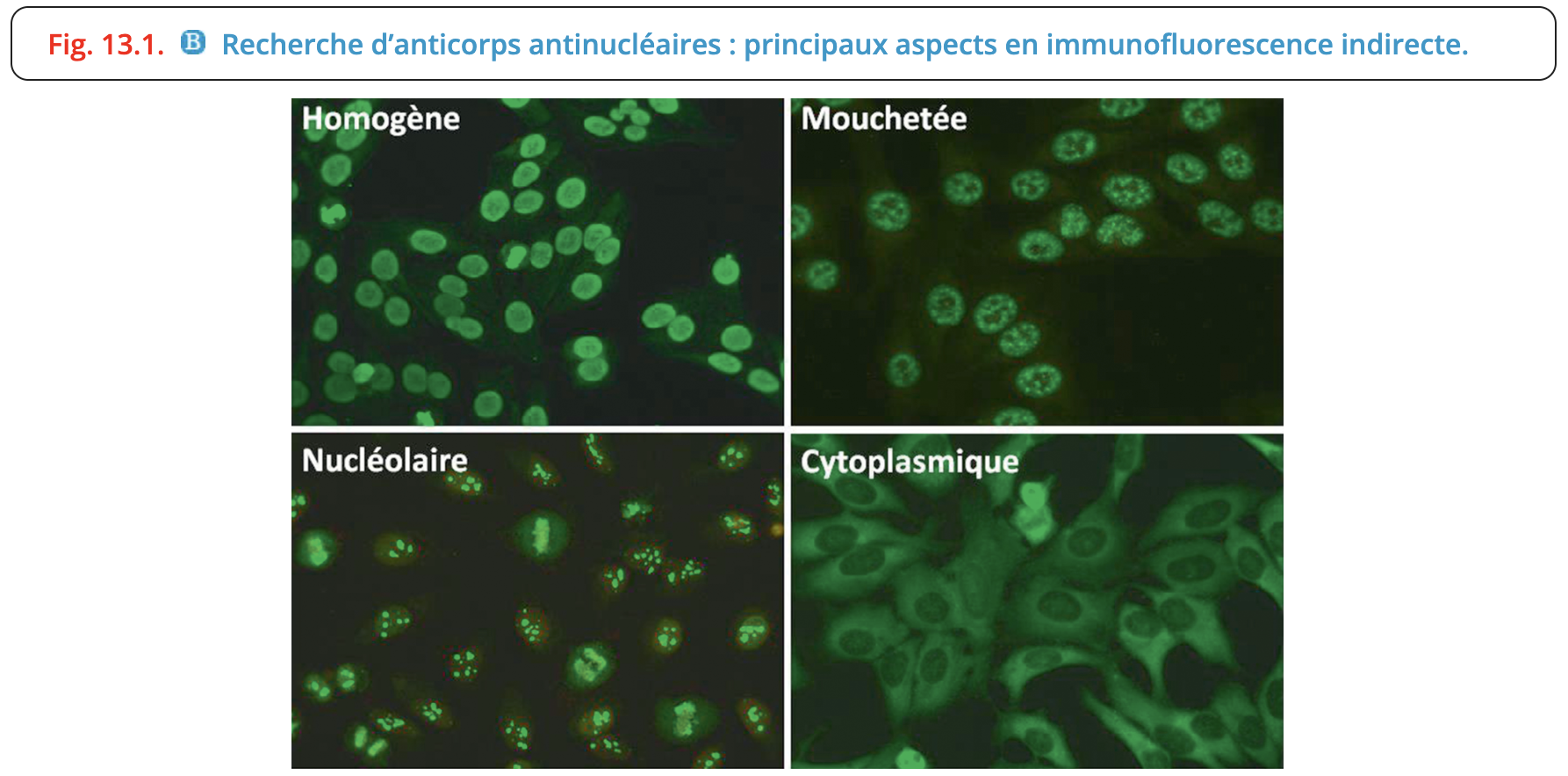 Patterns d'immunofluorescence indirecte sur cellules HEp-2 (homogène, mouchetée, nucléolaire, cytoplasmique)