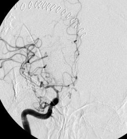 Angiographie spasme artère cérébrale antérieure