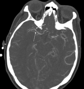 Angiographie spasme artère cérébrale moyenne