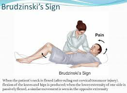 Signe de Brudzinski
