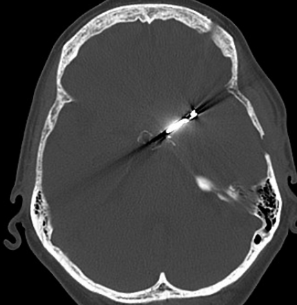 Clip chirurgical en TDM post-clippage