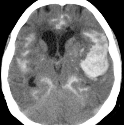 HSA + hématome intra-parenchymateux