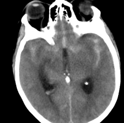 HSA + hémorragie intra-ventriculaire