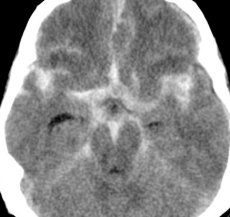 TDM HSA vue alternative