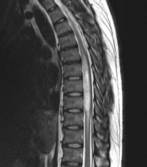 Astrocytome IRM 2