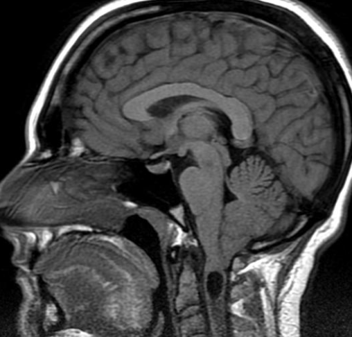 Chiari IRM 1