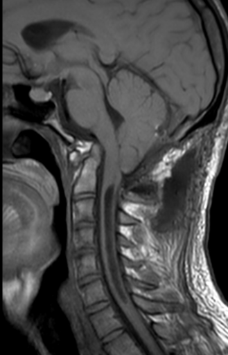 Chiari IRM 2