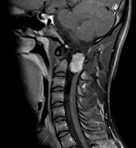 Méningiome rachidien IRM 2