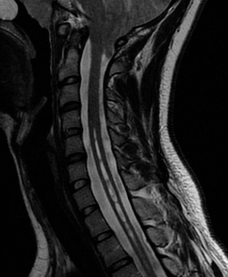 Syringomyélie IRM 1