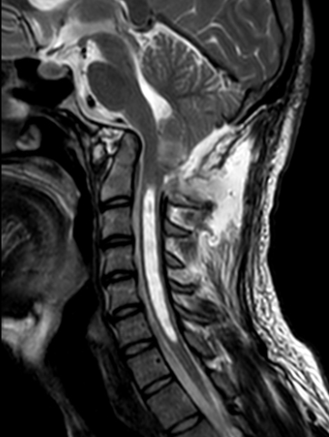 Syringomyélie IRM 2