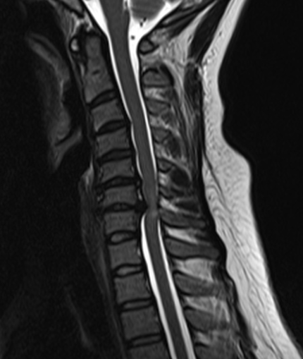 Myélopathie cervicale IRM 2