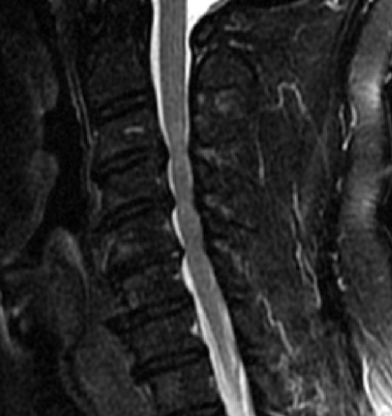 Myélopathie cervicale IRM 3
