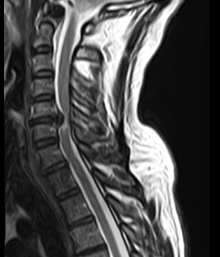 Myélopathie cervicale IRM 4