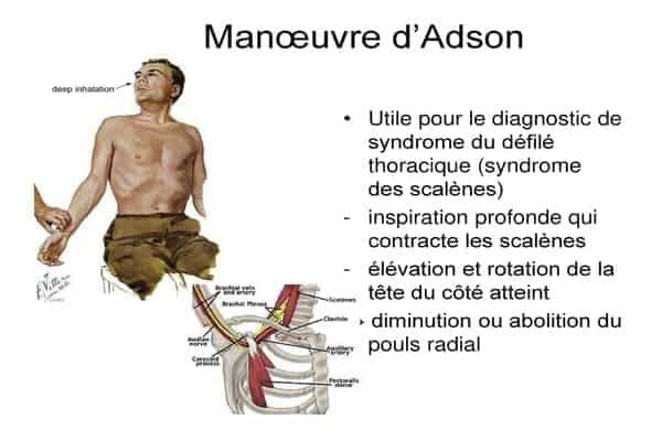 Défilé thoraco-brachial — vue 2