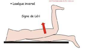 Lomboradiculalgie — vue alternative