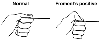 Signe de Froment (déficit adducteur du pouce)